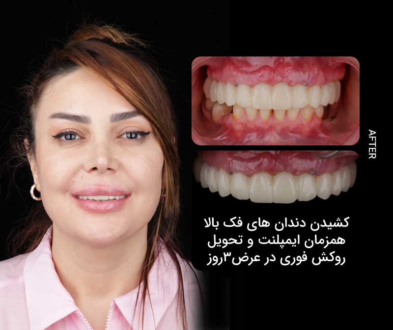 ایمپلنت کامل فک با تکنیک All-on-X و پروتز ثابت